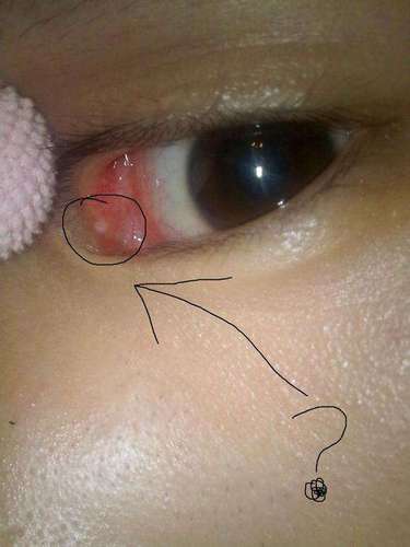 老太眼内8条活虫