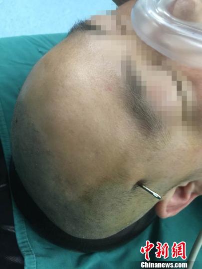 湖北一男子遭8厘米长钢钉入脑奇迹生还