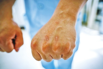 护士被病人抓伤是常事。