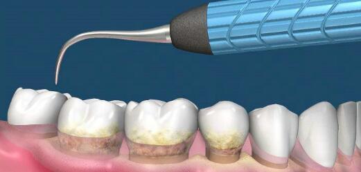 慎用牙签？牙缝真的越剔越大吗