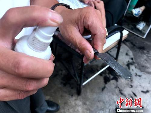 揭秘“刀锋洗眼”绝技：刀片贴着眼球划过（图）