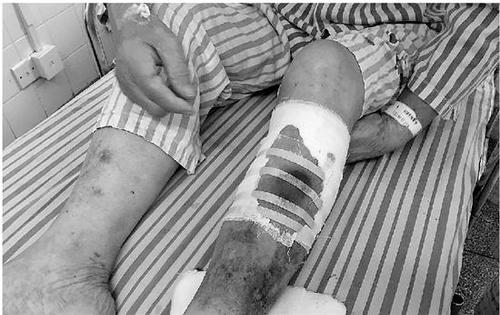 共享单车乱停放闯祸：84岁老人被绊倒缝20多针