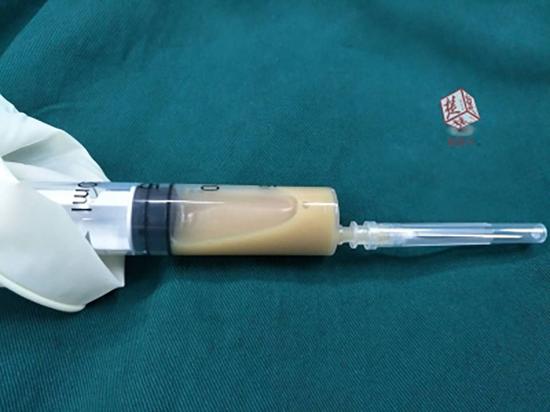 抽出来的脓液。