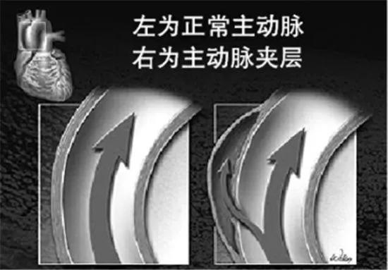 女子腹部剧痛第二天便去世 医生：这种病冬季高发