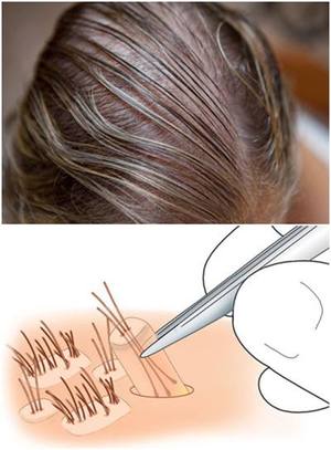 染烫会不会导致种植后的头发脱落？