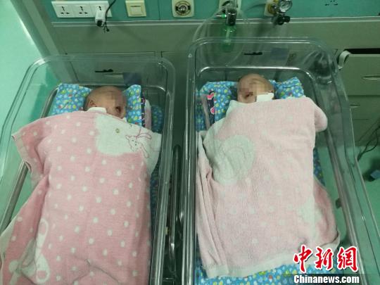 广西一对腹部连体男婴出生41天后成功分离