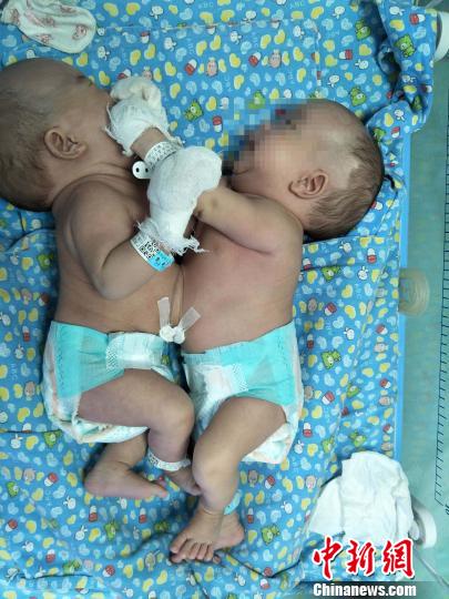 图为腹部连体男婴?！∈?摄