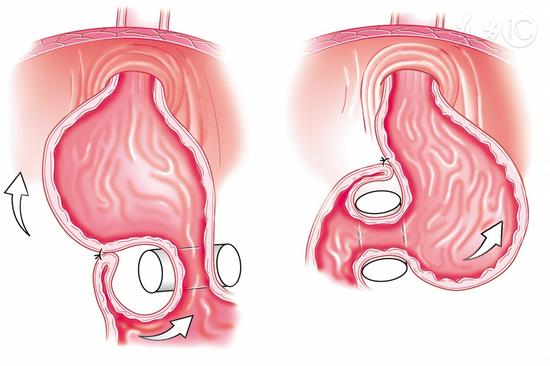 这种菌是胃癌凶手，一半中国人胃中都有它