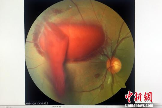 小潘的眼底照相检查图，红色块为眼底出血血块?！≈有?摄