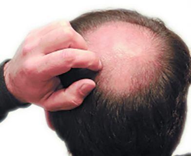 聪明绝顶？秃顶这件事 为何传男不传女？