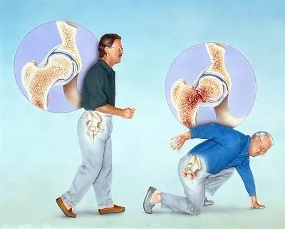 骨质疏松性骨折的特点：