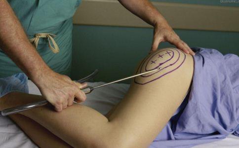 腿部吸脂分几个部位 腿部吸脂的方法有哪些 腿部吸脂有哪些优势