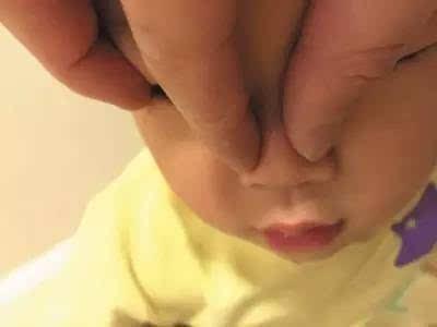 捏鼻梁让宝宝鼻子变挺？小心诱发2种病