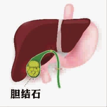 如何护理胆结石？高危人群要注意