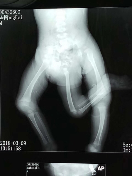 男婴出生时有三条腿和两个骨盆 医生:原本是双胞胎