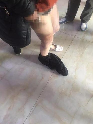 江苏一精神病人入院后遭粗暴约束 涉事护工被辞