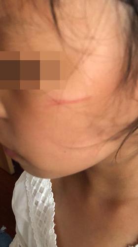 上海幼儿园多名孩子被划伤 疑似保育员所为