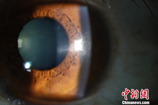 术后2年，患者角膜透明。供图