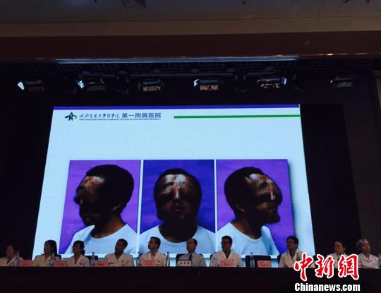 小伙患病貌似“狮面”，经手术重获新颜?！〕掠?摄