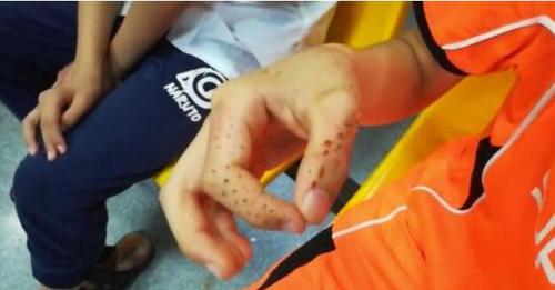 好痛！仙人掌从15楼砸下 男孩耳朵成“马蜂窝”