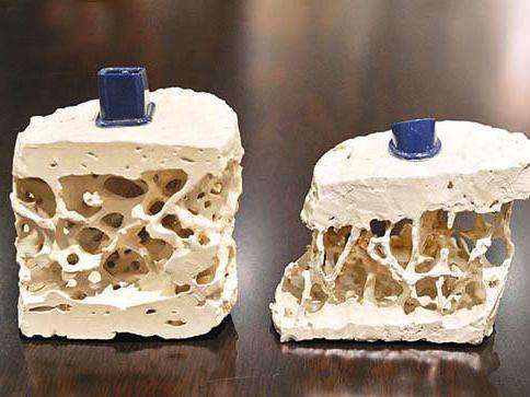 养骨就学这4个秘诀 提早储备骨骼“银行”