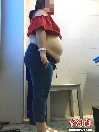 湖南高校女生肚内藏巨大包块囊液相当于24瓶矿泉水