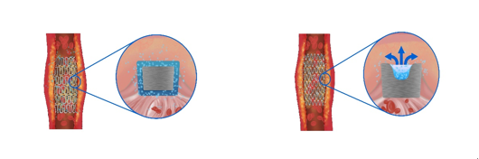 传统药物支架的药物在植入血管后向四周漫灌）（“火鹰支架”微槽和点灌技术使支架植入血管后药物精准释放