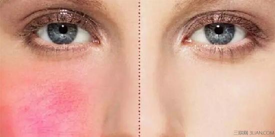 脸上红血丝形成的原因是什么？ 