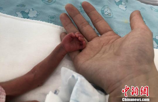 图为宝宝的小手。(院方供图) 张娅子 摄