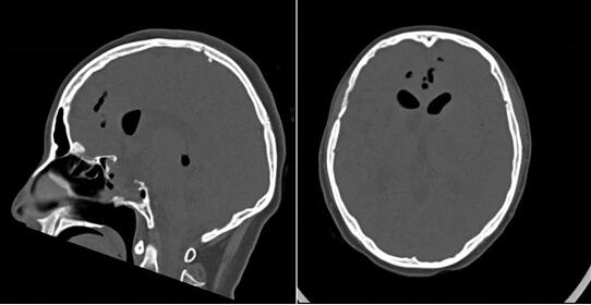 大脑里的液体从鼻腔流出怎么办