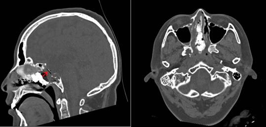 大脑里的液体从鼻腔流出怎么办