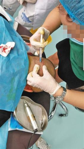 6月26日，北京源之美诊所，心理学出身的培训师焦老师正为学员示范注射头皮麻醉药。