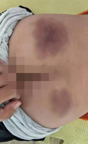 山东临沂一小学老师被指体罚学生 官方:已介入调查